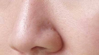 skin-purging-vs-breakout-the-difference