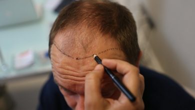 hair transplant surgery los angeles