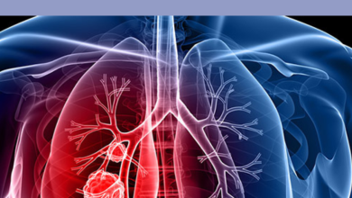 Lung Cancer