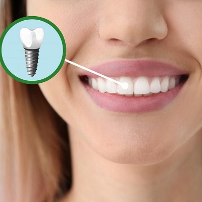 How Painful are Dental Implants