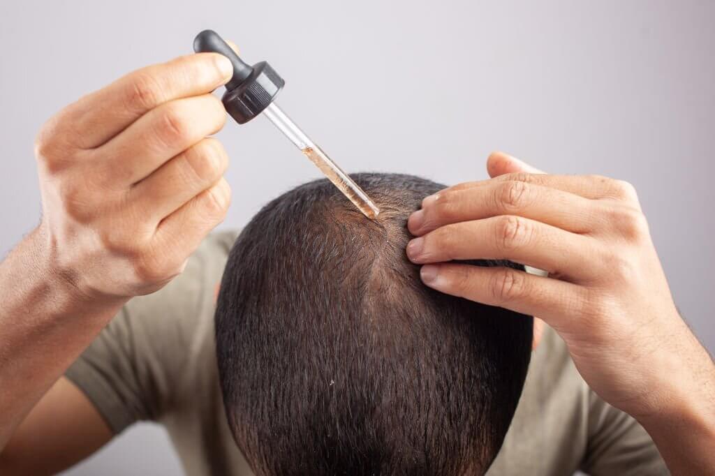 MINOXIDIL 5%